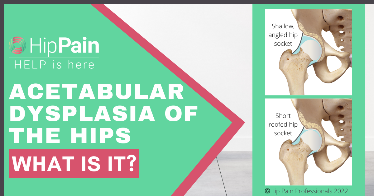 What is acetabular dysplasia of the hips