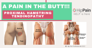 What is proximal hamstring tendinopathy?